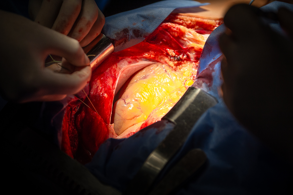 Операція на серці. 2