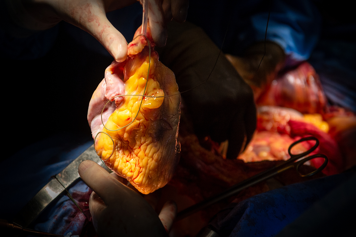 Операція на серці. 6