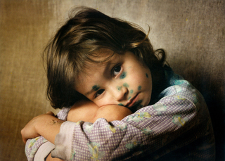 Опять ветрянка